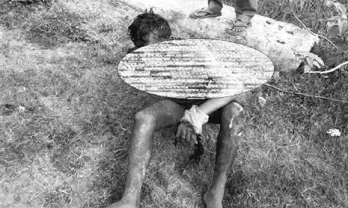 सतना के अमरपाटन में एसिड अटैक से हड़कंप, दोस्तों पर तेजाब डालने का लगाया आरोप