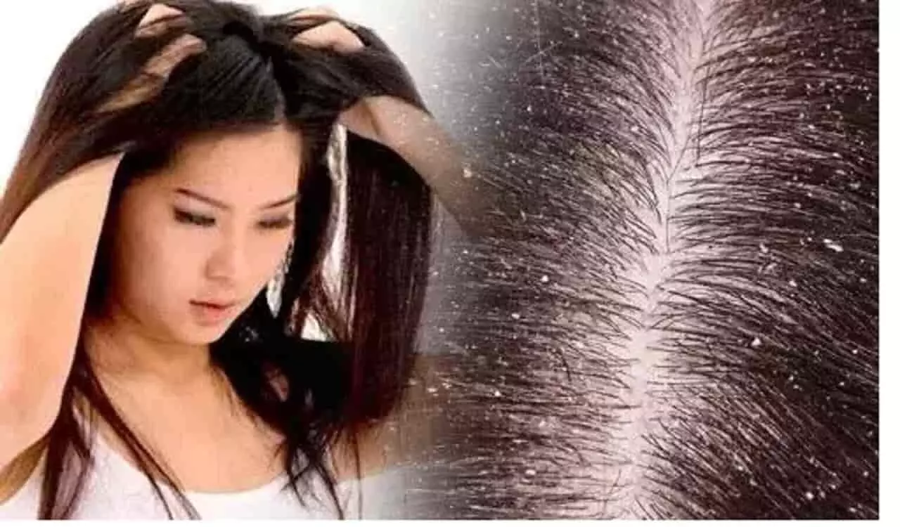 Dandruff Home Remedies: डैंड्रफ से हैं परेशान तो अपनाएं ये घरेलू  नुस्खे