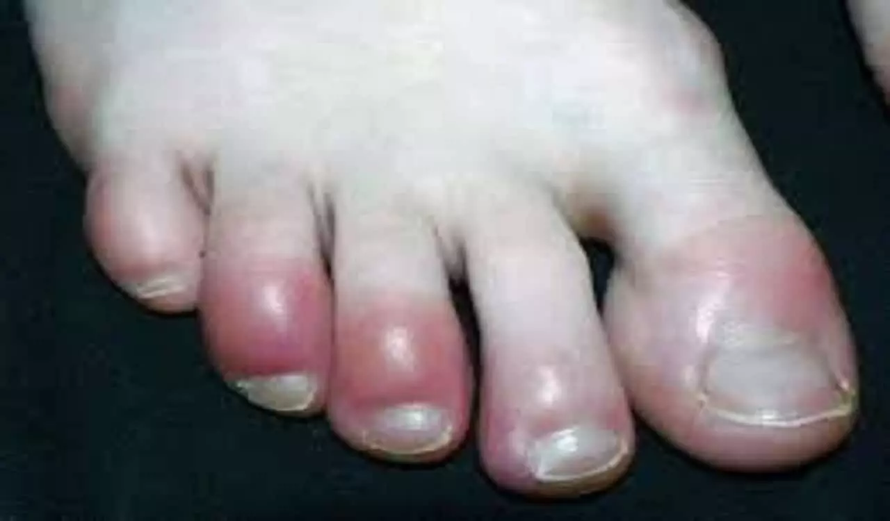 Toes Care: सर्दियों में पैरों की उंगलियों की सूजन को करें कम, अपनाएं ये घरेलू नुस्खे