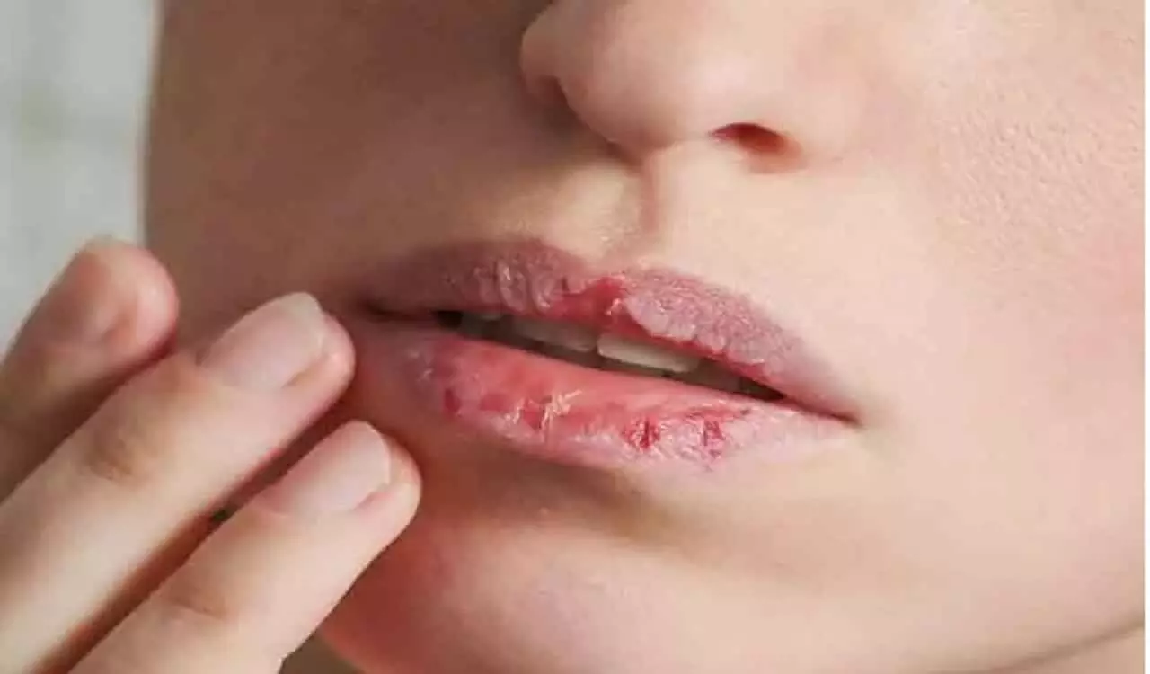 Lip Care Tips: सर्दियों में अपने होठों को फटने से बचाये, अपनाएँ ये टिप्स