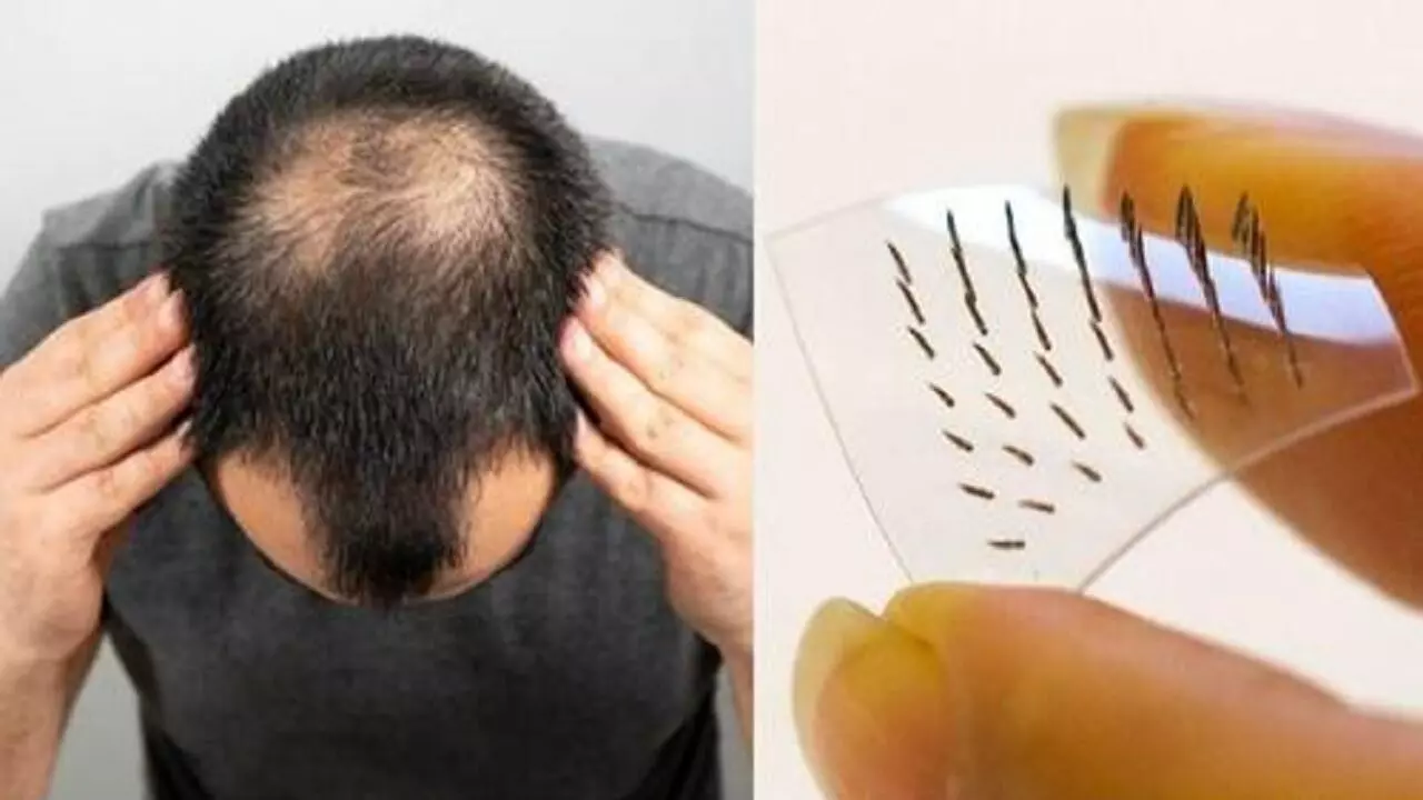 सरपट खोपड़ी में उगेगी बालों की झोपडी, साइंटिस्ट्स ने गंजेपन के का इलाज खोज लिया है दोस्त सरपट खोपड़ी में उगेगी बालों की झोपडी, साइंटिस्ट्स ने गंजेपन के का इलाज खोज लिया है दोस्त