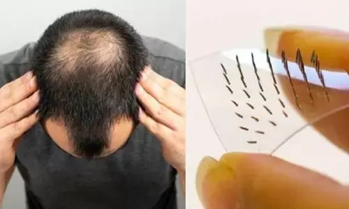 सरपट खोपड़ी में उगेगी बालों की झोपडी, साइंटिस्ट्स ने गंजेपन के का इलाज खोज लिया है दोस्त