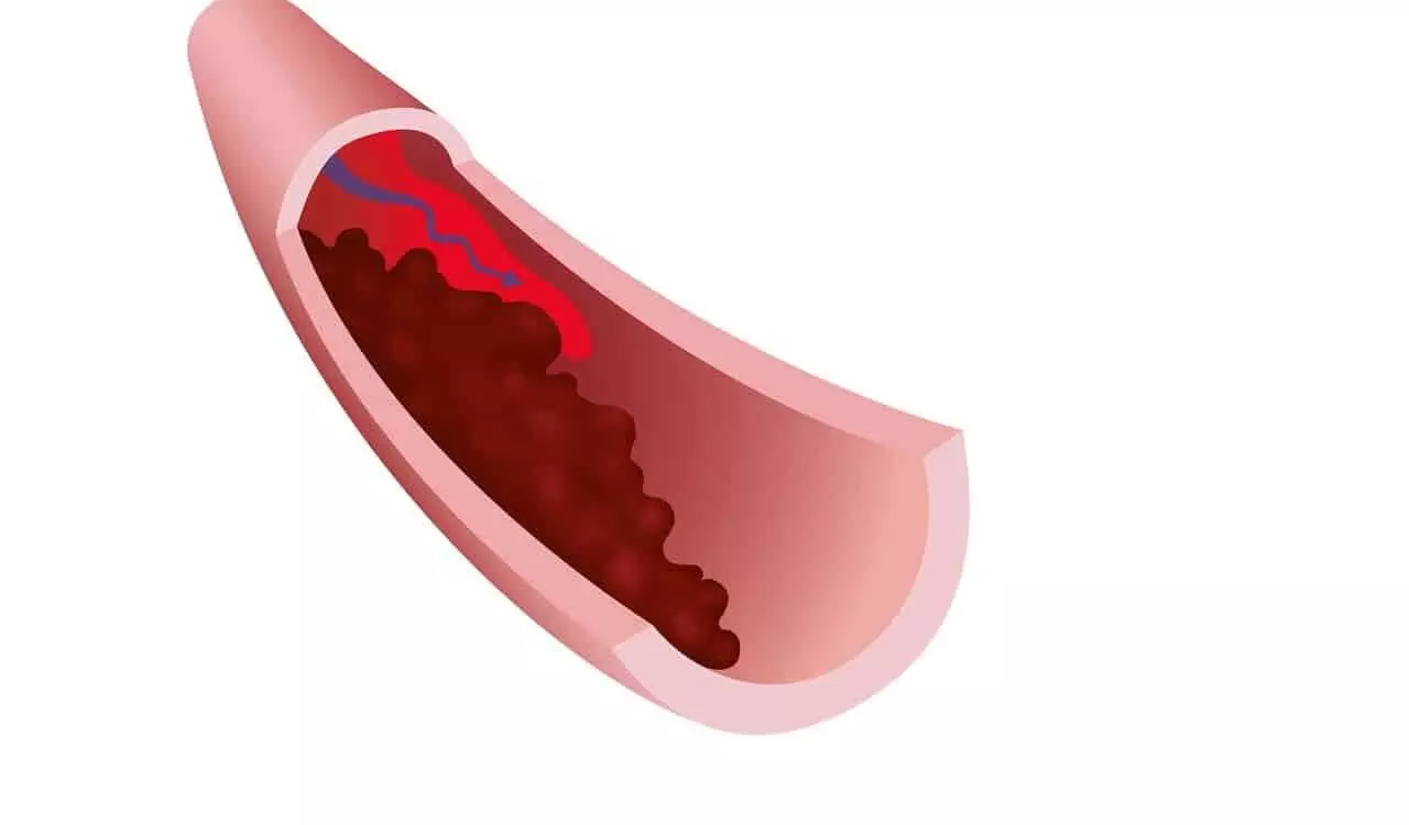 ब्लड क्लॉट के लक्षण: Blood Clot Ke Lakshan ब्लड क्लॉट के लक्षण: Blood Clot Ke Lakshan
