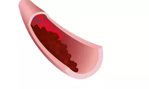 ब्लड क्लॉट के लक्षण: Blood Clot Ke Lakshan