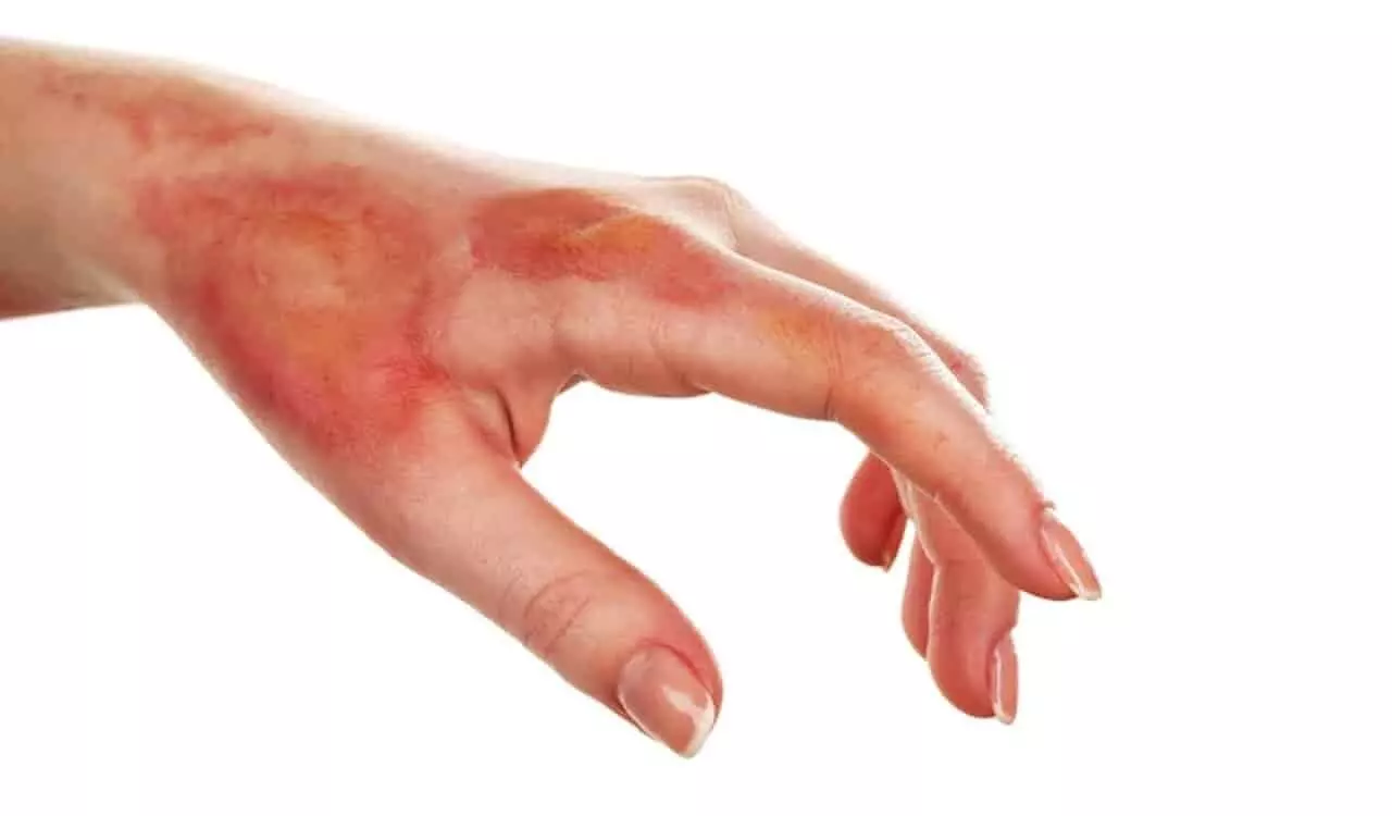 Home Remedies For Skin Burn: जल गए हैं तो तुरंत अपनाएँ ये घरेलू नुस्खे