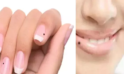 शरीर के इस हिस्से में है तिल तो, अवश्य ही आपको मिलेगी दौलत शरीर के इस हिस्से में है तिल तो, अवश्य ही आपको मिलेगी दौलत