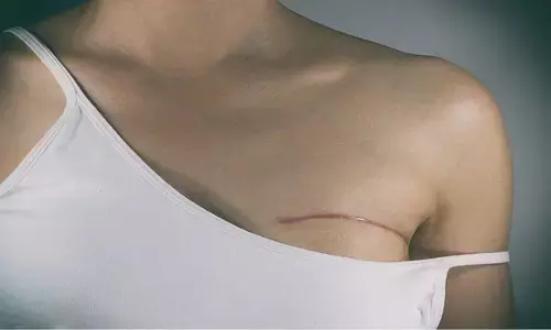 Honeybee Venom Treats Breast Cancer: मधुमक्खी का विष ब्रेस्ट कैंसर के 100% सेल्स को ख़त्म कर सकता है