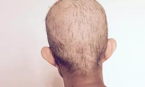 Chemotherapy के बाद हेयर ग्रोथ के लिए कुछ इंपोर्टेंट टिप्स