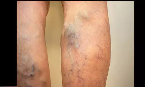 varicose veins varicose veins