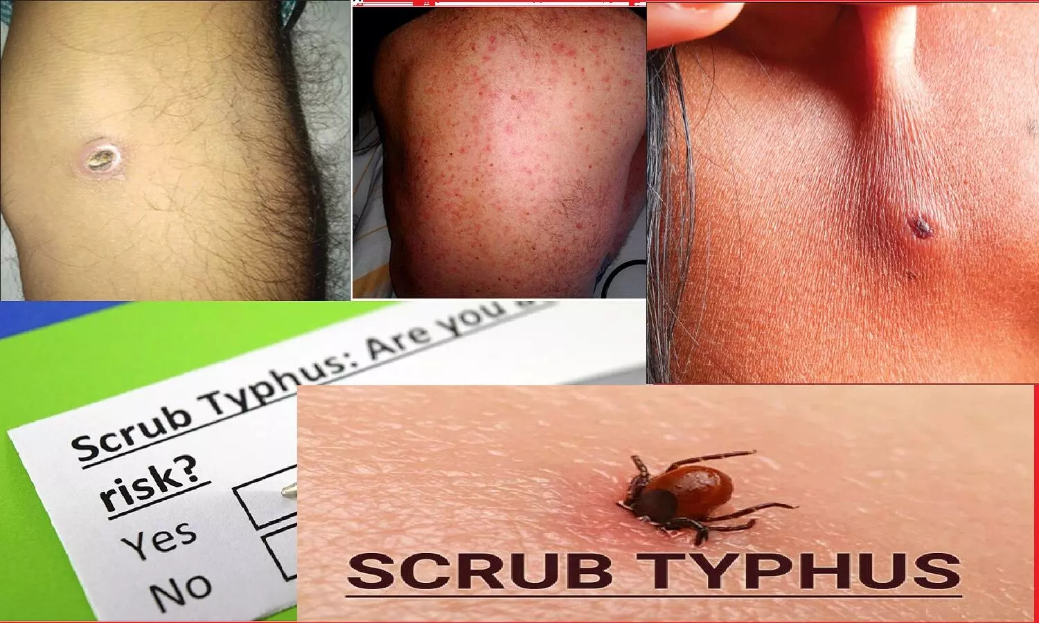 Scrub Typhus: एमपी में तेज़ी से फ़ैल रही स्क्रब टाइफस बीमारी,  3 जिलों में अलर्ट, क्या है स्क्रब टाइफस