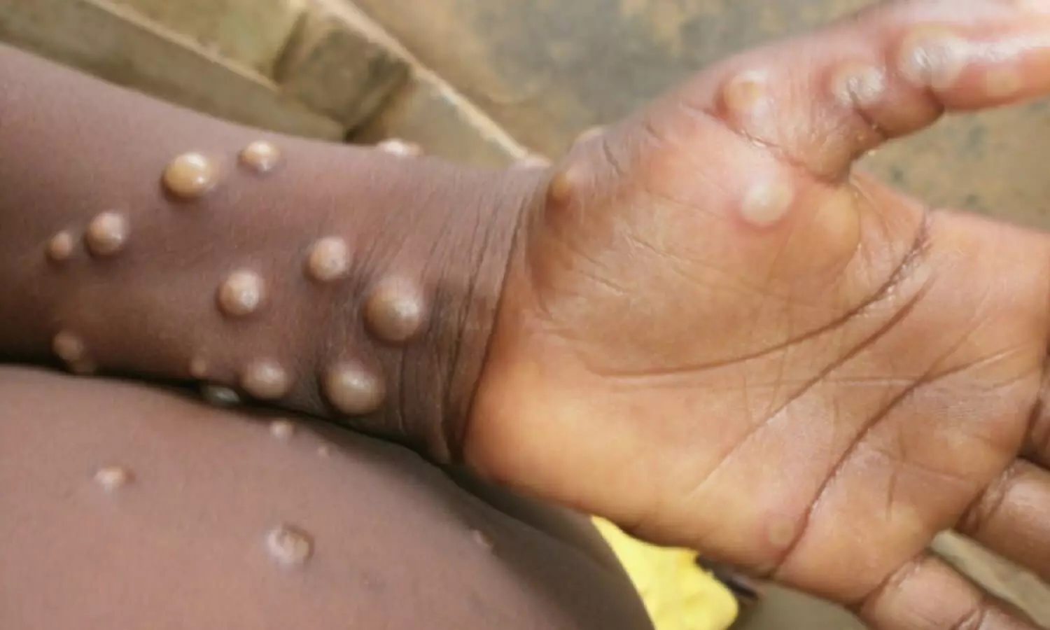 Monkeypox virus