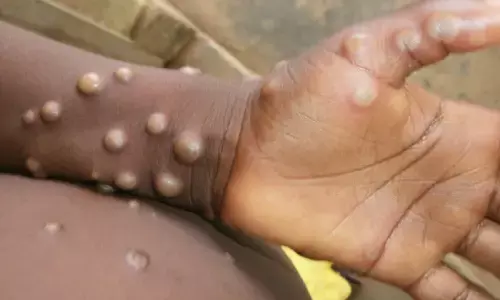 Monkeypox virus
