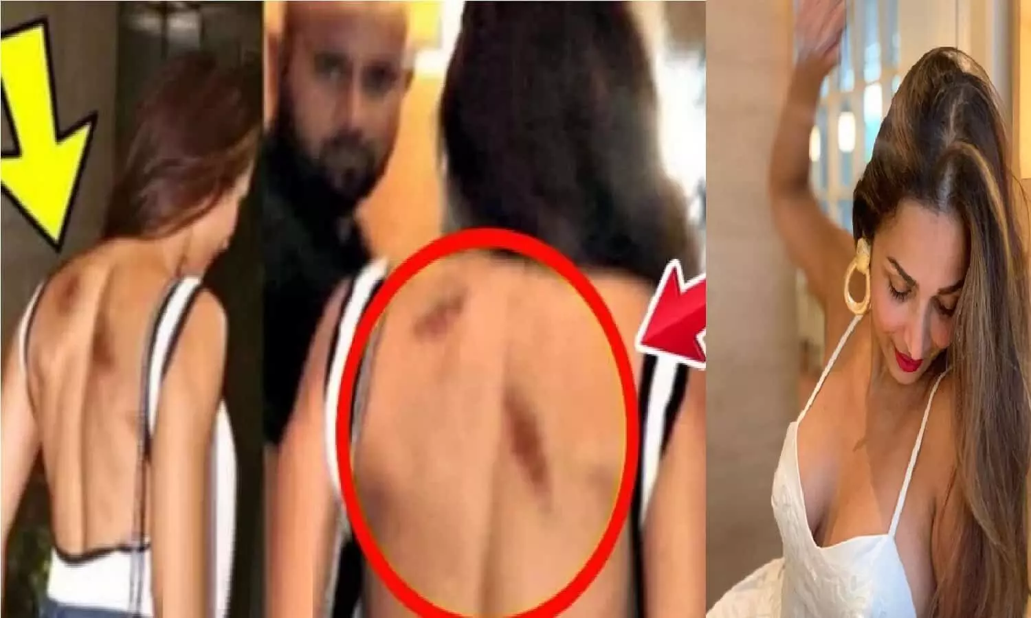 Arjun Kapoor ने Malaika Arora का किया ऐसा हाल, पीठ में दिखा गहरा घाव Arjun Kapoor ने Malaika Arora का किया ऐसा हाल, पीठ में दिखा गहरा घाव