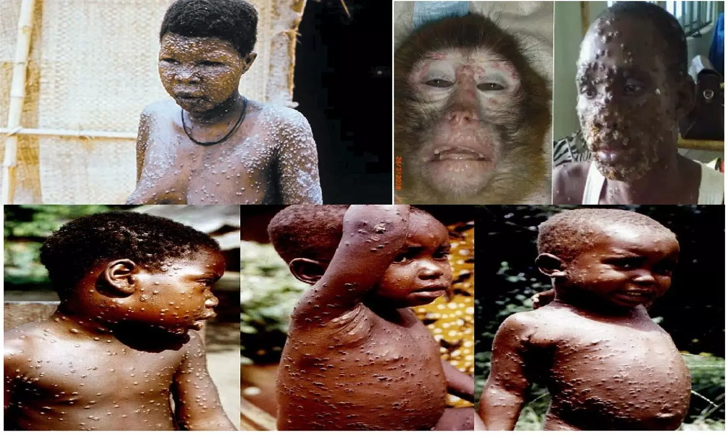 What Is Monkey Pox Virus: मंकी पॉक्स एक भयानक वायरस है, भगवान करे कि किसी दुश्मन को भी न हो