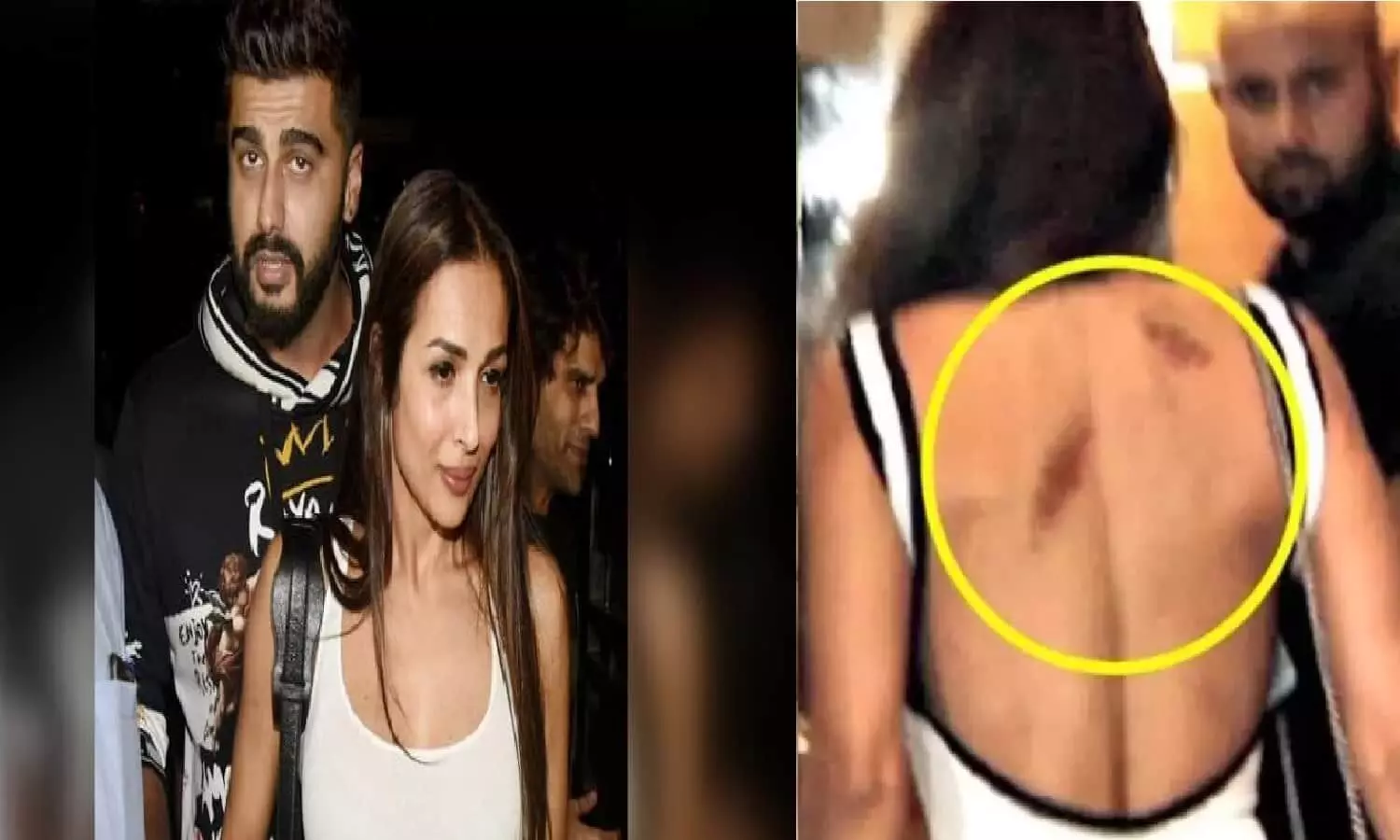 Arbaaz Khan का नाम लेने पर Arjun Kapoor ने Malaika Arora का किया ऐसा हाल, पीठ में हर जगह लगी चोट