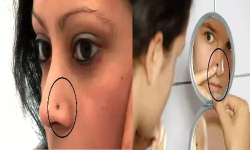 Mole on Nose: यदि आपकी पत्नी व गर्लफ्रेंड के नाक में है तिल तो ये खबर पढ़ हिल जाएंगे आप Mole on Nose: यदि आपकी पत्नी व गर्लफ्रेंड के नाक में है तिल तो ये खबर पढ़ हिल जाएंगे आप
