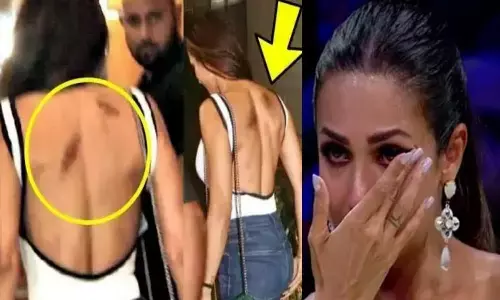 Malaika Arora की Arjun Kapoor ने की हालत ख़राब, मलाइका के पीठ में जख्म देकर कर डाला ये कांड