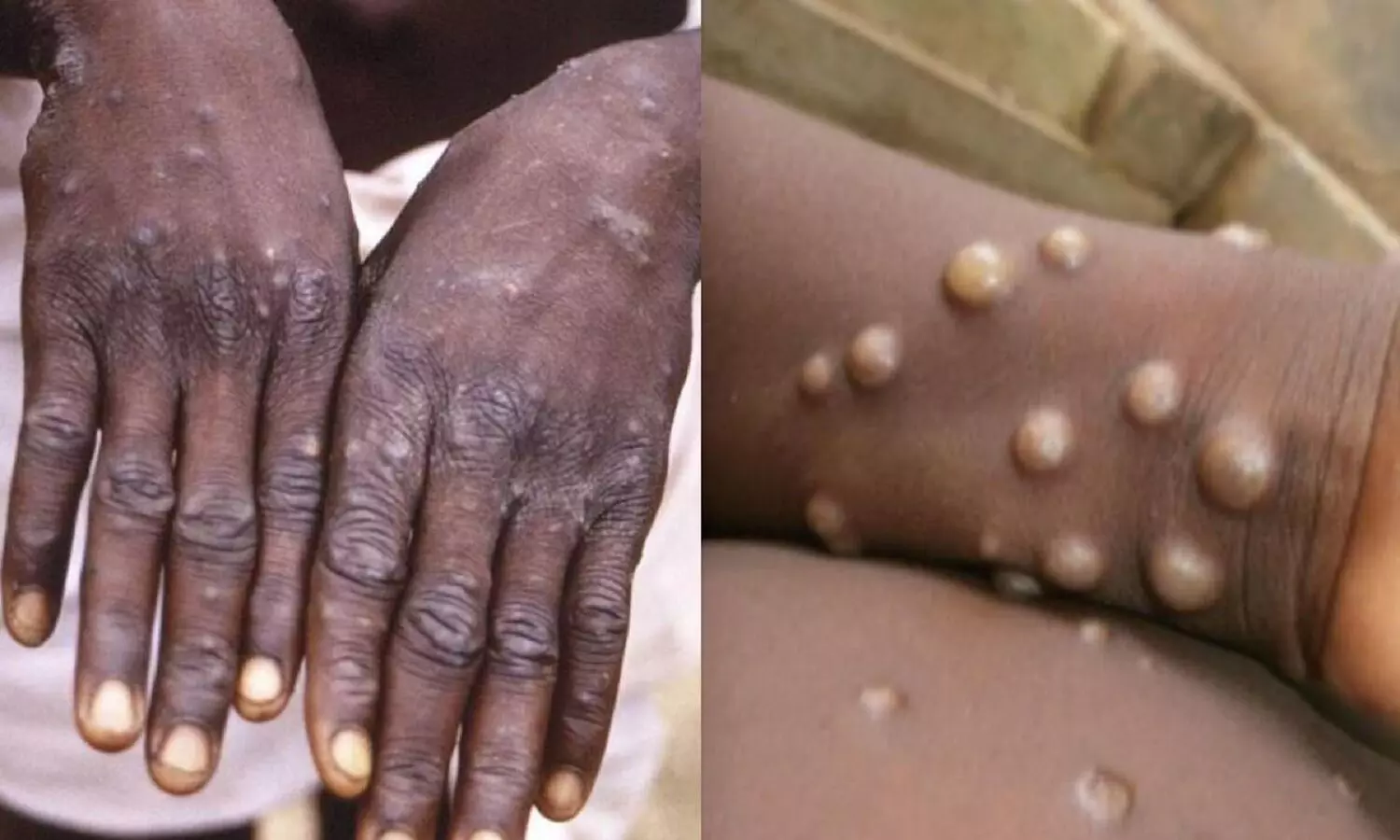 Monkeypox India Cases: भारत में मंकिपॉक्स से पहली मौत, संक्रमित सिर्फ 22 साल का था Monkeypox India Cases: भारत में मंकिपॉक्स से पहली मौत, संक्रमित सिर्फ 22 साल का था