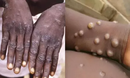 Monkeypox India Cases: भारत में मंकिपॉक्स से पहली मौत, संक्रमित सिर्फ 22 साल का था Monkeypox India Cases: भारत में मंकिपॉक्स से पहली मौत, संक्रमित सिर्फ 22 साल का था