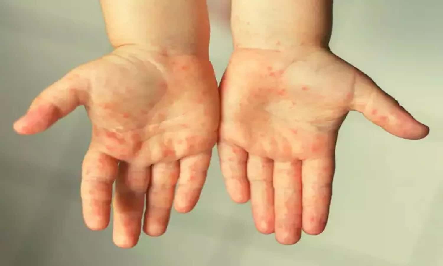 बच्चों में फैल रही HFMD नामक बीमारी, दिखें यह लक्षण तो फौरन करें डॉक्टर