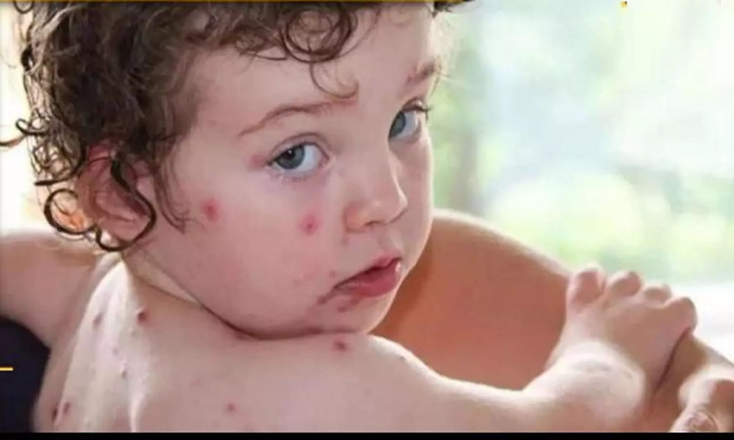 Tomato Flu: टोमैटो फ्लू क्या है? जानें लक्षण और उपचार