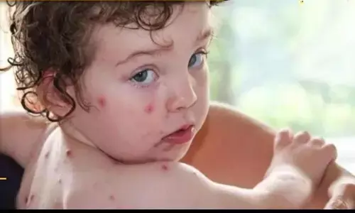 Tomato Flu: टोमैटो फ्लू क्या है? जानें लक्षण और उपचार