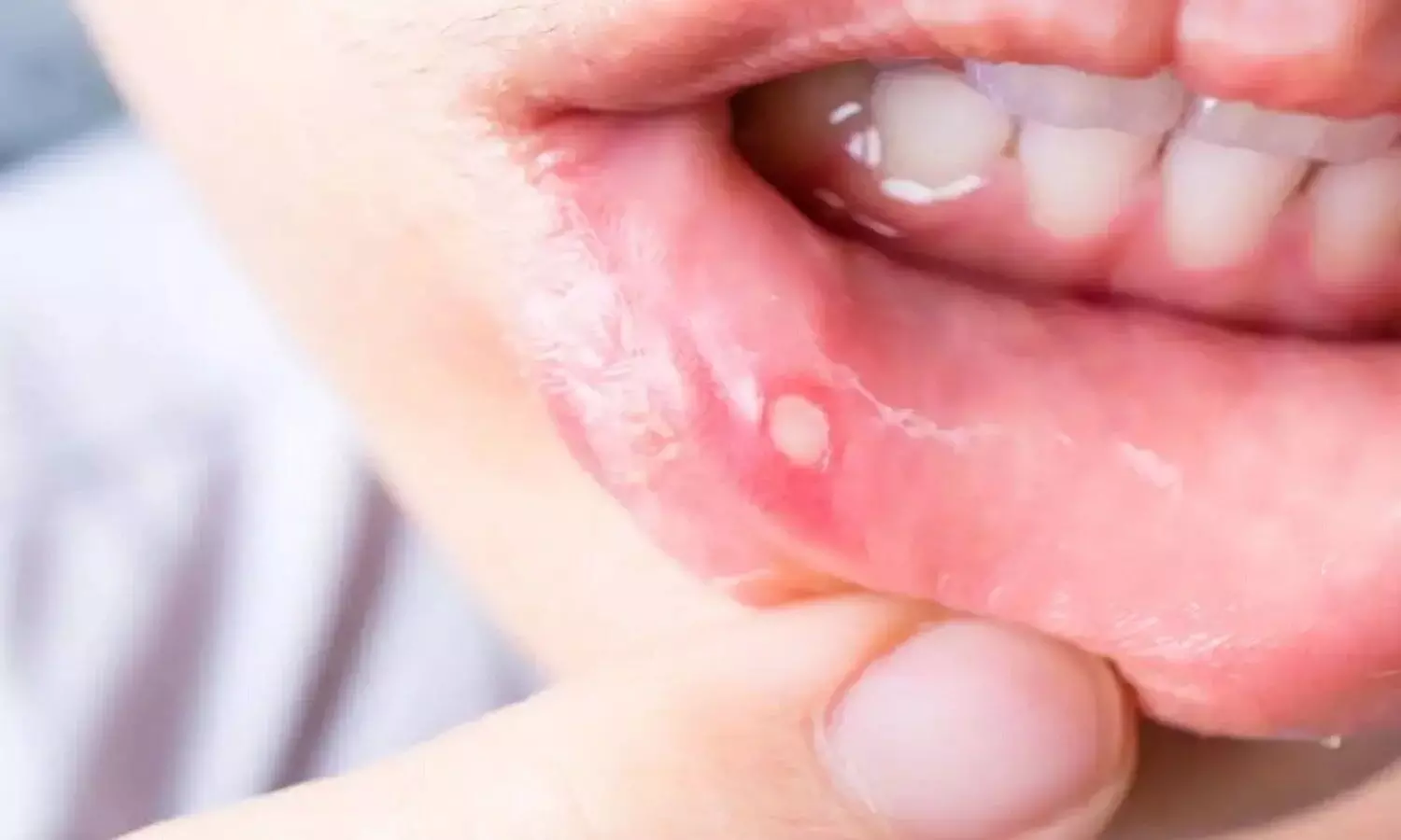 Mouth Ulcer Treatment: मुंह में छाले क्यों पड़ते हैं, छालों का घरेलू उपचार दिलाएंगे तुरंत आराम, जानें