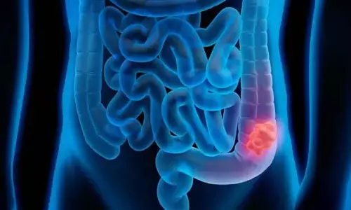 Colon Cancer : इन चीजों से होता है पेट का कैंसर, आज से ही करें तौबा Colon Cancer : इन चीजों से होता है पेट का कैंसर, आज से ही करें तौबा