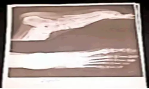 एमपी का एक ऐसा सरकारी अस्पताल जहां मरीजों को फोटोकॉपी वाले कागज में थमाया जा रहा एक्सरे प्रिंट