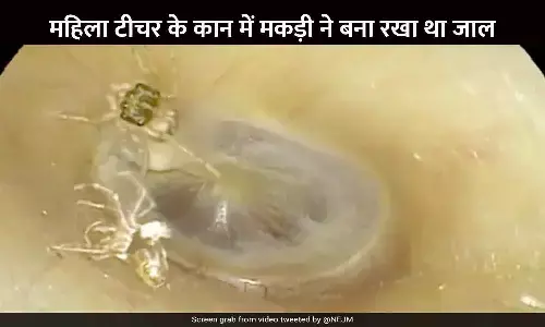 महिला टीचर के कान में मकड़ी ने बना रखा था जाल, आती थी खरोंचने की आवाज; कानों की नियमित सफाई न करना पड़ा भारी महिला टीचर के कान में मकड़ी ने बना रखा था जाल, आती थी खरोंचने की आवाज; कानों की नियमित सफाई न करना पड़ा भारी