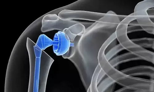 रीवा में पहली बार हुई शोल्डर रिप्लेसमेंट की जटिल सर्जरी