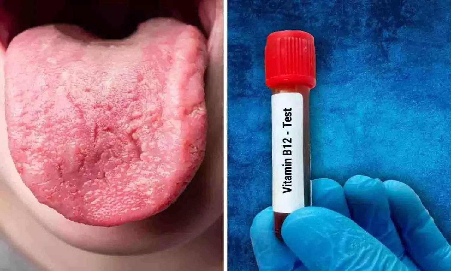 विटामिन B12 की कमी के लक्षण और इलाज | Vitamin B12 Deficiency Cure विटामिन B12 की कमी के लक्षण और इलाज | Vitamin B12 Deficiency Cure