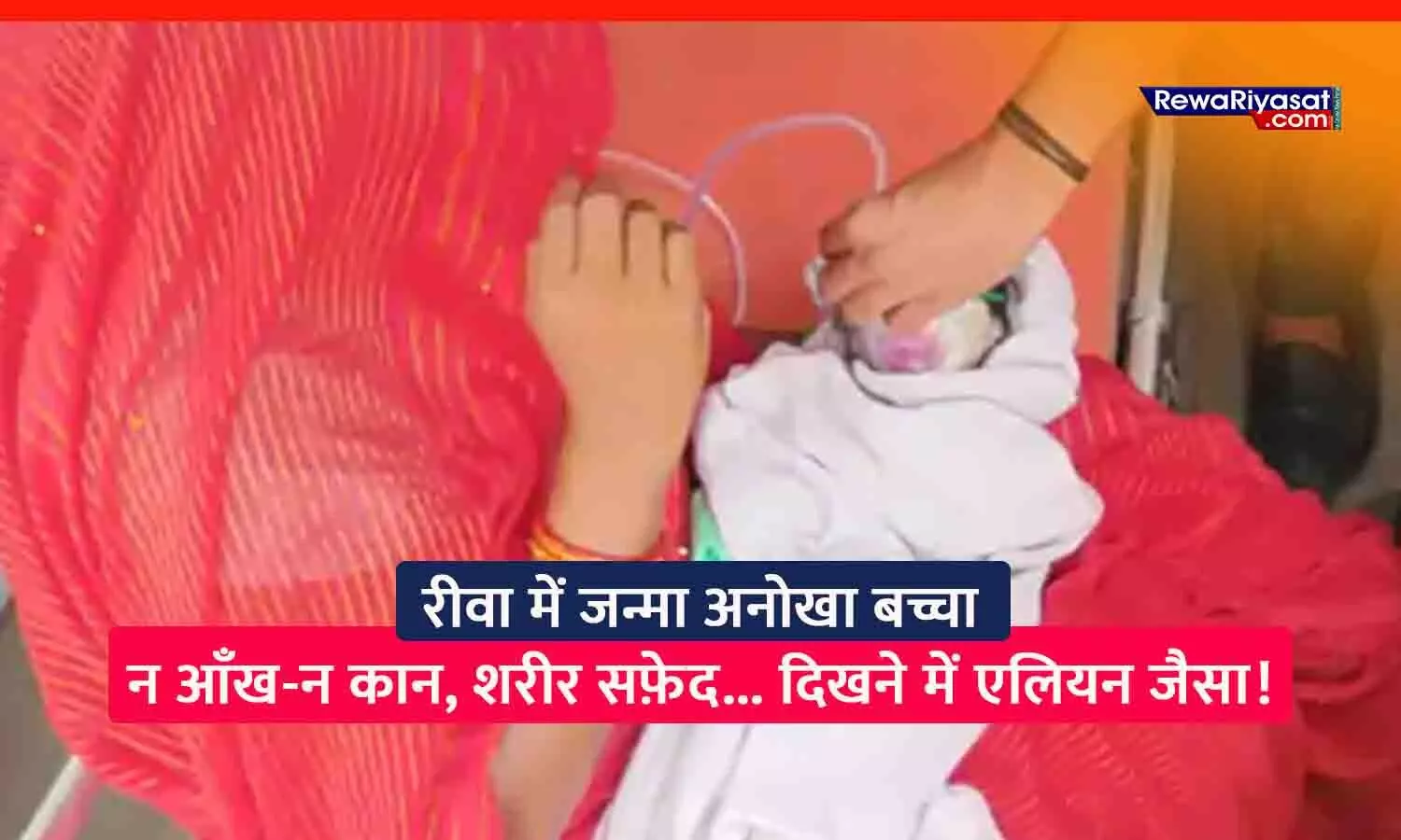 रीवा में एलियन जैसा दिखने वाला नवजात चर्चा में: शरीर सफ़ेद, बिना आँख-कान के जन्मा; हालत नाजुक