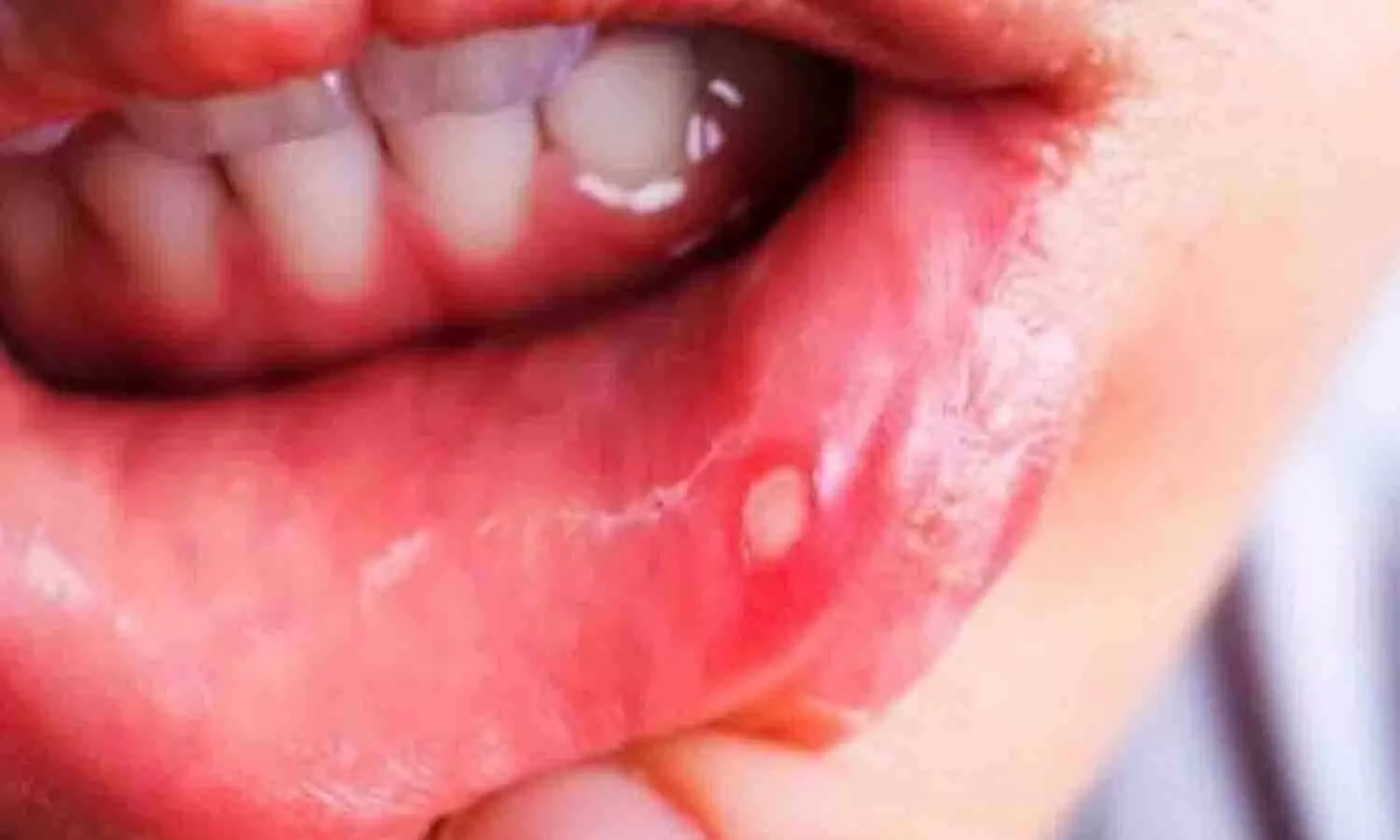 Acharya Balkrishna Mouth Ulcer Remedy: मुंह के छालों का आयुर्वेदिक इलाज Acharya Balkrishna Mouth Ulcer Remedy: मुंह के छालों का आयुर्वेदिक इलाज