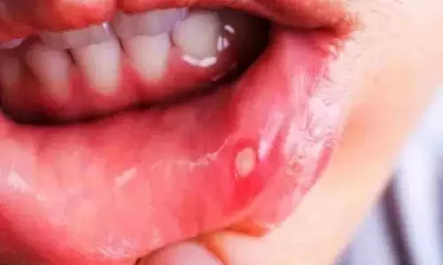 Acharya Balkrishna Mouth Ulcer Remedy: मुंह के छालों का आयुर्वेदिक इलाज