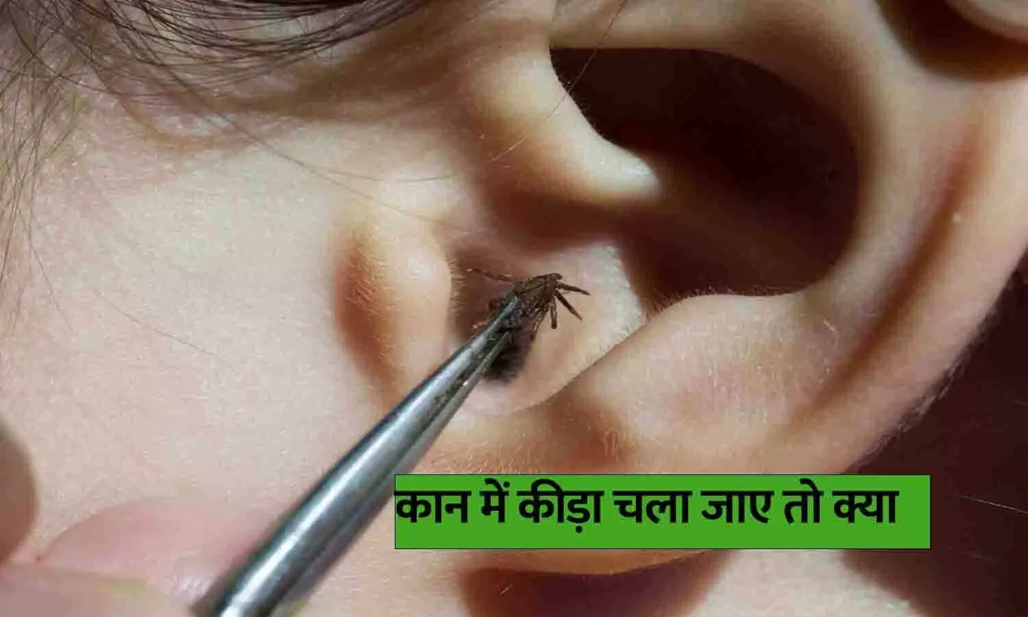 कान में कीड़ा चला जाए तो क्या करें? जानें लक्षण, घरेलू उपाय और कब जाएं डॉक्टर के पास
