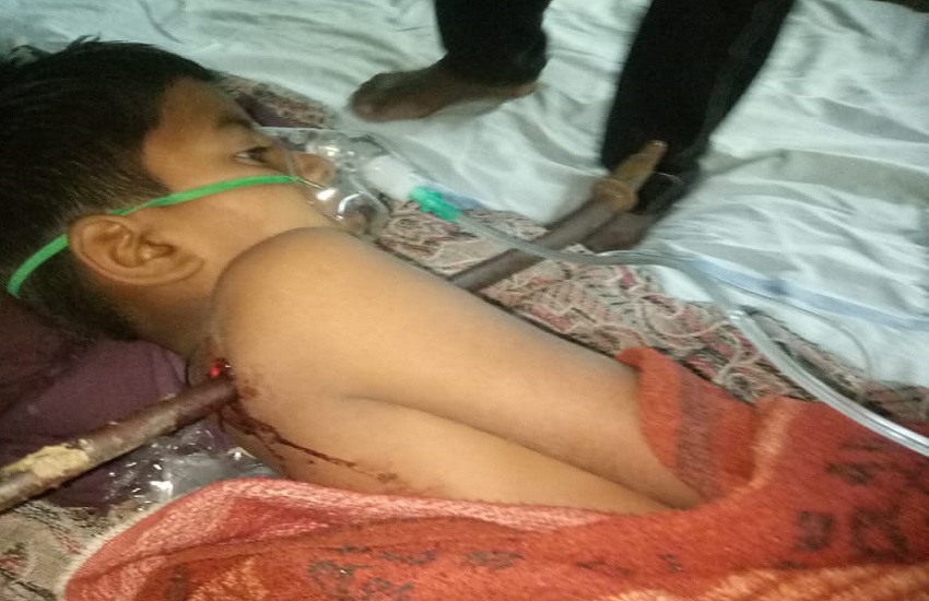 रीवा में 5 साल के बच्चे की छाती में घुसी पांच फ़ीट की सरिया, मौत और जिंदगी के बीच जूझता बच्चा