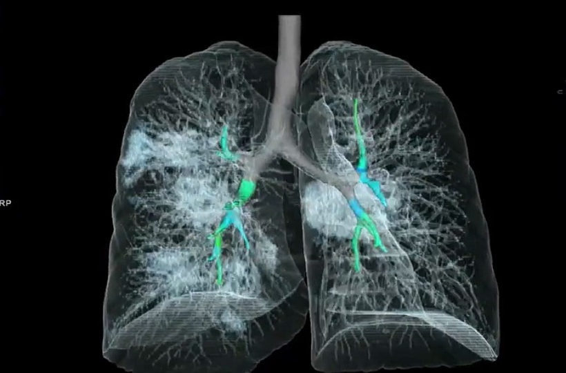कोरोना के मरीज के फेफड़े की पहली 3D तस्वीर सामने आई, हवा की जगह कुछ और ही दिखा! जानिए कहाँ कितने संक्रमित...
