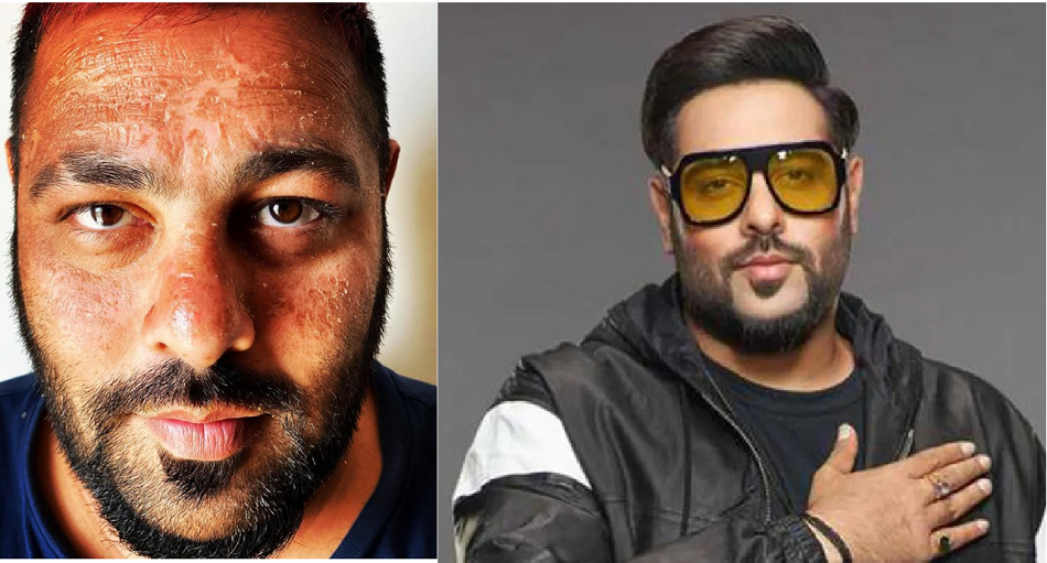 छुट्टी मना रहे रैपर बादशाह के चेहरे का हुआ ऐसा हाल की देखकर निकल आएंगे आंसू..