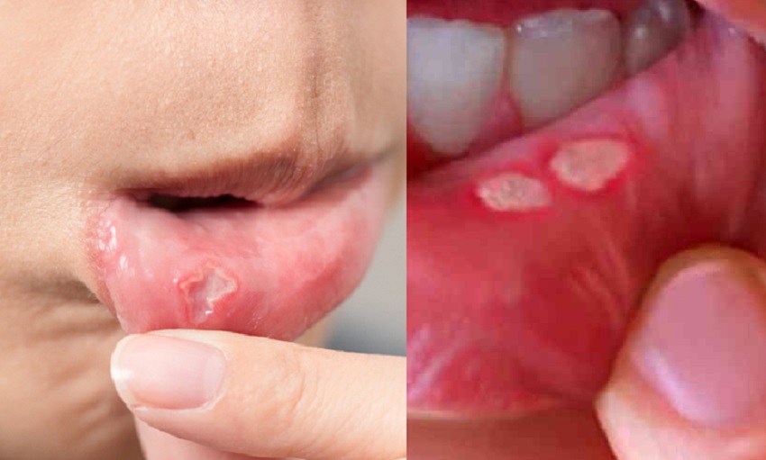 मुंह के छालों को इन घरेलू नुस्खों से करें ठीक -Home Remedies Of Mouth Ulcers