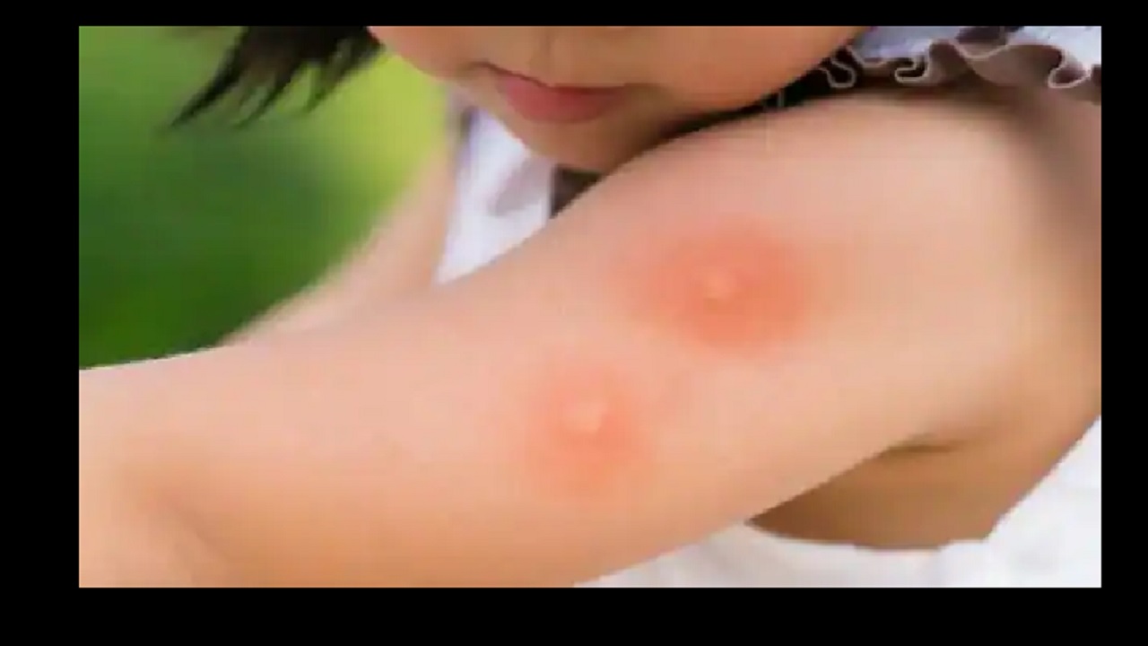 How To Treat Mosquito Bite : मच्छर काटने से शरीर पर पड़ जाते है लाल चकत्ते, होती है &nbsp;खुजली तो इन घरेलू नुस्खों से पाएं निजात