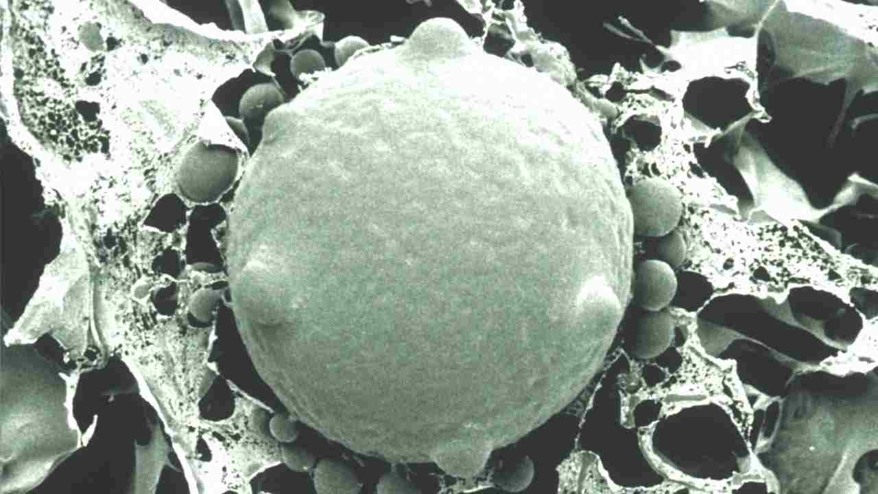 White Fungus की वजह से Covid Positive महिला की आंत में हुए कई छेद, देश में आया पहला मामला